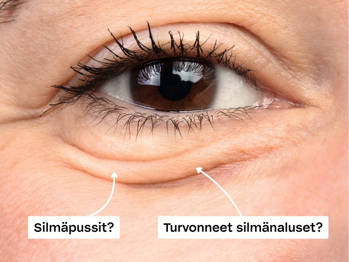 Lähikuva silmänalusesta, jossa nuolet osoittavat silmäpussit ja turvotuksen silmien ympärillä.
