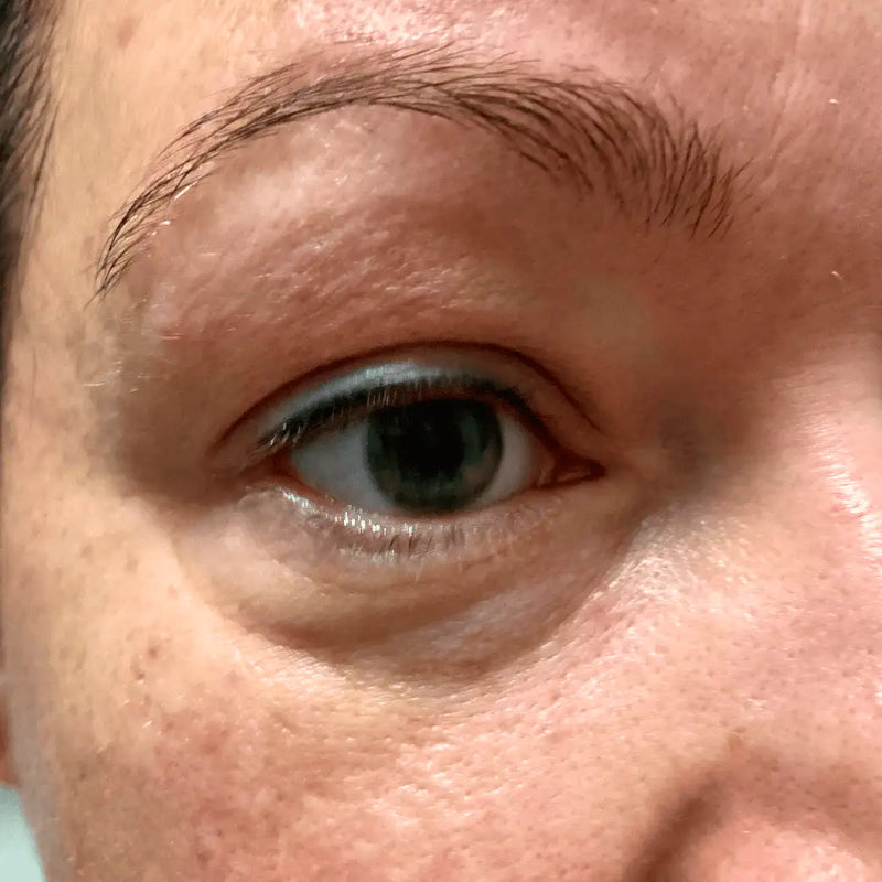 Silmäpussit ennen Botanical Eye Liftiä — nestekertymä silmän alla ja tummat silmänaluset