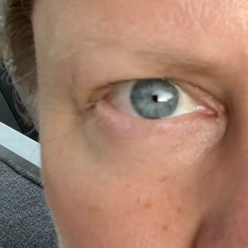 Silmänympärysiho 7 päivää Botanical Eye Lift käytön jälkeen — silmäpussit ja tummuus vähentyneet näkyvästi